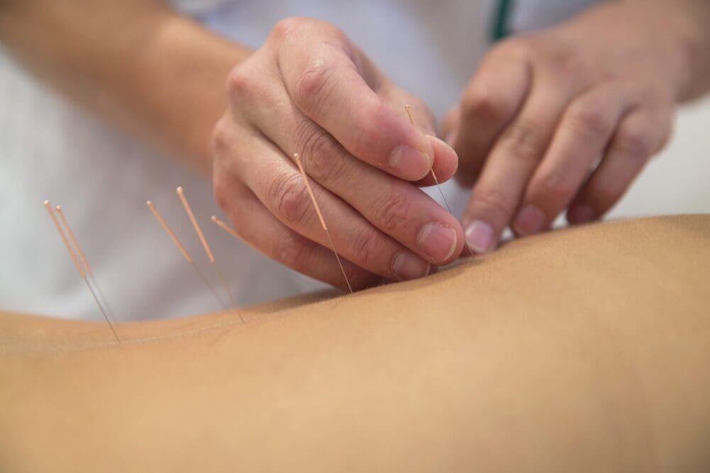 Accupuncture