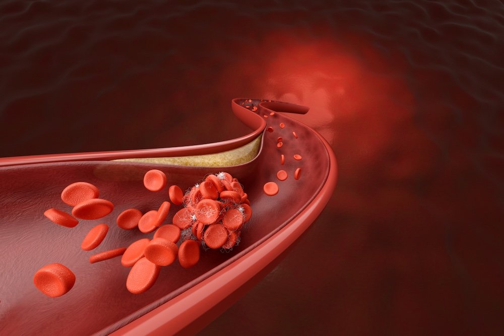 Blood Clot