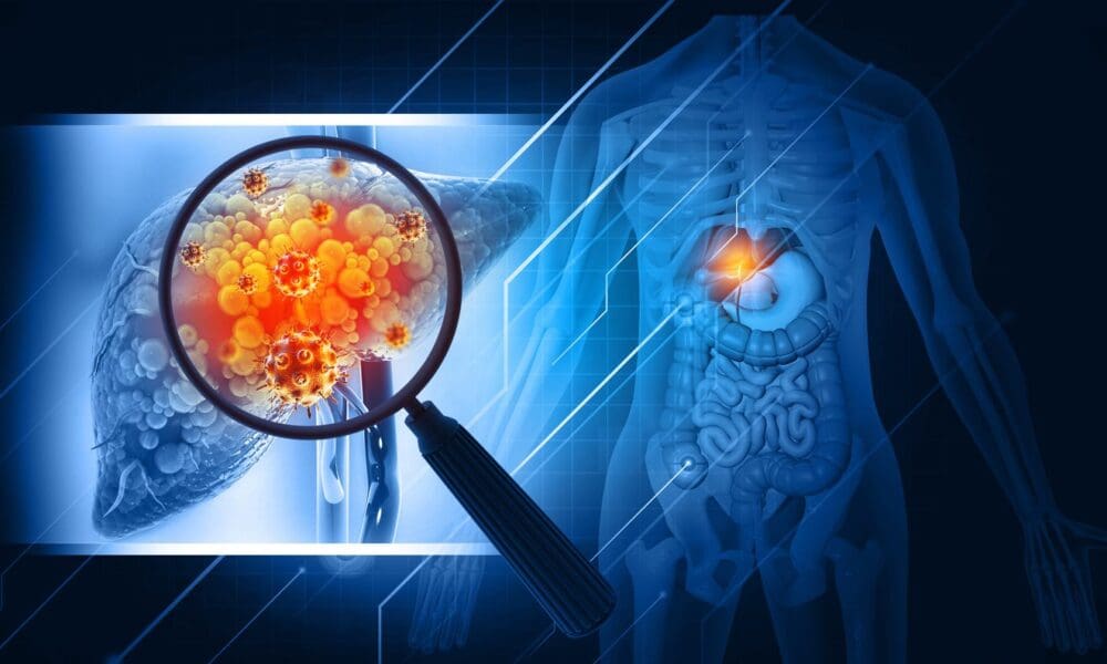 liver-disease